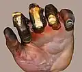۴th degree burn