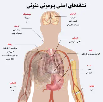 A diagram of the human body outlining the key symptoms of pneumonia