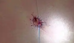 بخیه‌های نهایی که ناف (که به عنوان "ناف" نیز شناخته می‌شود) را پس از ابدومینوپلاستی در موقعیت جدید خود محکم می‌کنند