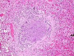 Acute inflammatory exudate occluding the lumen of the bronchiole and acute inflammation of part of the wall of the bronchiole