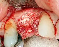 اگر پهنای استخوان ناکافی باشد، می‌توان آن را با استفاده از قطعات استخوان مصنوعی یا جسد دوباره رشد داد تا به عنوان داربستی برای رشد استخوان طبیعی در اطراف آن عمل کند.