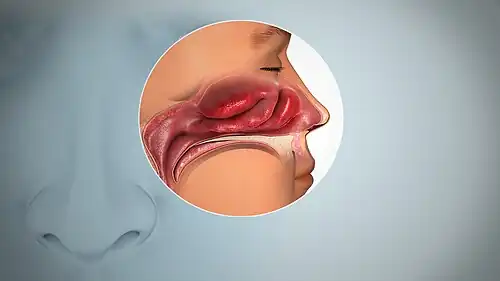 نمای کناری از سینوس‌های بویایی که تورم غشاء مخاطی را نشان می‌دهد.