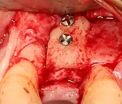 استخوان گرفته شده از محل دیگری (معمولاً پشت فک پایین) می‌تواند در صورت نیاز به مقدار بیشتری استخوان، در همان فرد به محل ایمپلنت پیوند زده شود.