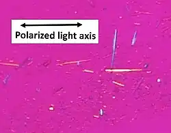 کریستال‌های اسید اوریک در نور پلاریزه، birefringence  منفی را نشان می‌دهند، با رنگ زرد در حالت موازی با محور جبران‌کننده قرمز و آبی در حالت عمود بر آن..