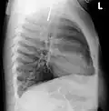 سکه ای که در CXR جانبی در مری دیده می‌شود