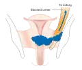 مرحله 3B سرطان دهانه رحم