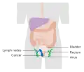 مرحله سوم سرطان مقعد