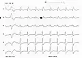 یک تریس ECG