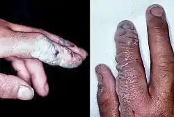 دست‌های چپ و راست، نمای دوگانه، سوختگی در انگشتان اشاره