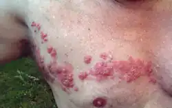 زونای قفسهسینه