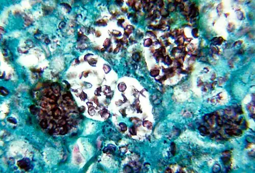 H. capsulatum. Methenamine نقره ای رنگ.