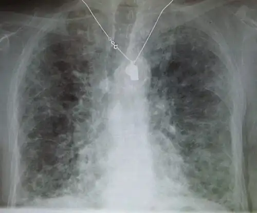 A chest X-ray demonstrating pulmonary fibrosis. By history, the pulmonary fibrosis is thought to be due to آمیودارون.