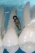 ایمپلنت ارتودنسی در کنار دندان‌ها قرار می‌گیرد تا به عنوان نقطه لنگر عمل کند و بریس‌ها بتوانند به آن متصل شوند.