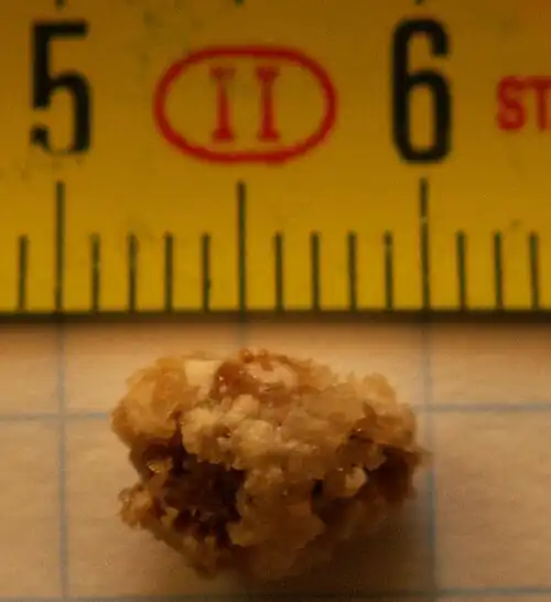 A color photograph of a kidney stone, 8 millimeters in diameter.