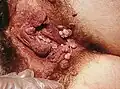 زگیل تناسلی در اندام جنسی زنانه