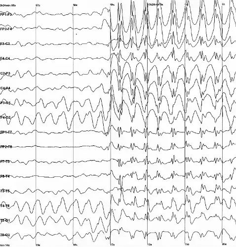 An electroencephalogram of a person with childhood absence epilepsy showing a seizure. The waves are black on a white background.
