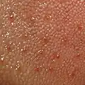 نقاط قرمز بر روی زبان