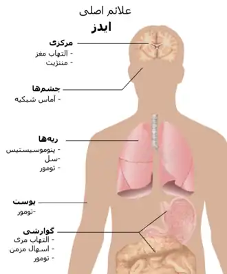  تصویر نیم تنه انسان که در آن شایع‌ترین علائم ایدز مشخص شده‌است