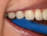 Plastic wedge to identify pain on biting from a fractured tooth